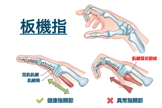 扳機指是手指或拇指卡在彎曲位置然後突然彈直的情況。病因是由於活動手指的肌腱發炎腫脹，與周圍的腱鞘沾黏卡住，導致手指難以活動。(Photo by handsurgerytaiwan.com)