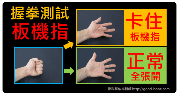 自我測試「板機指」：握緊拳頭後鬆開，如果手指會卡住、伸展不順，並且有痛楚，很可能就是板機指喔！(Photo by good-bone.com)